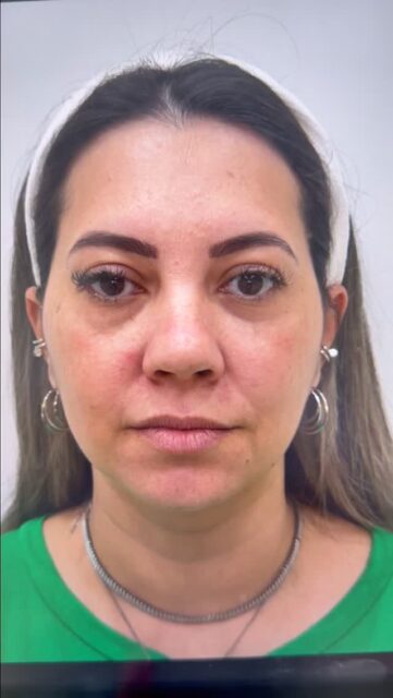 A Gi não mudou de rosto.
Agora há mais definição, proporção e naturalidade! ✨

Resultado bem feito não chama atenção pelo excesso.
Chama atenção pela leveza!

Quando ela diz que a autoestima está lá em cima, eu sei que o objetivo foi alcançado. ✅

Se você quer se olhar no espelho e se sentir assim também,
Vem, que eu cuido de você! 🌻