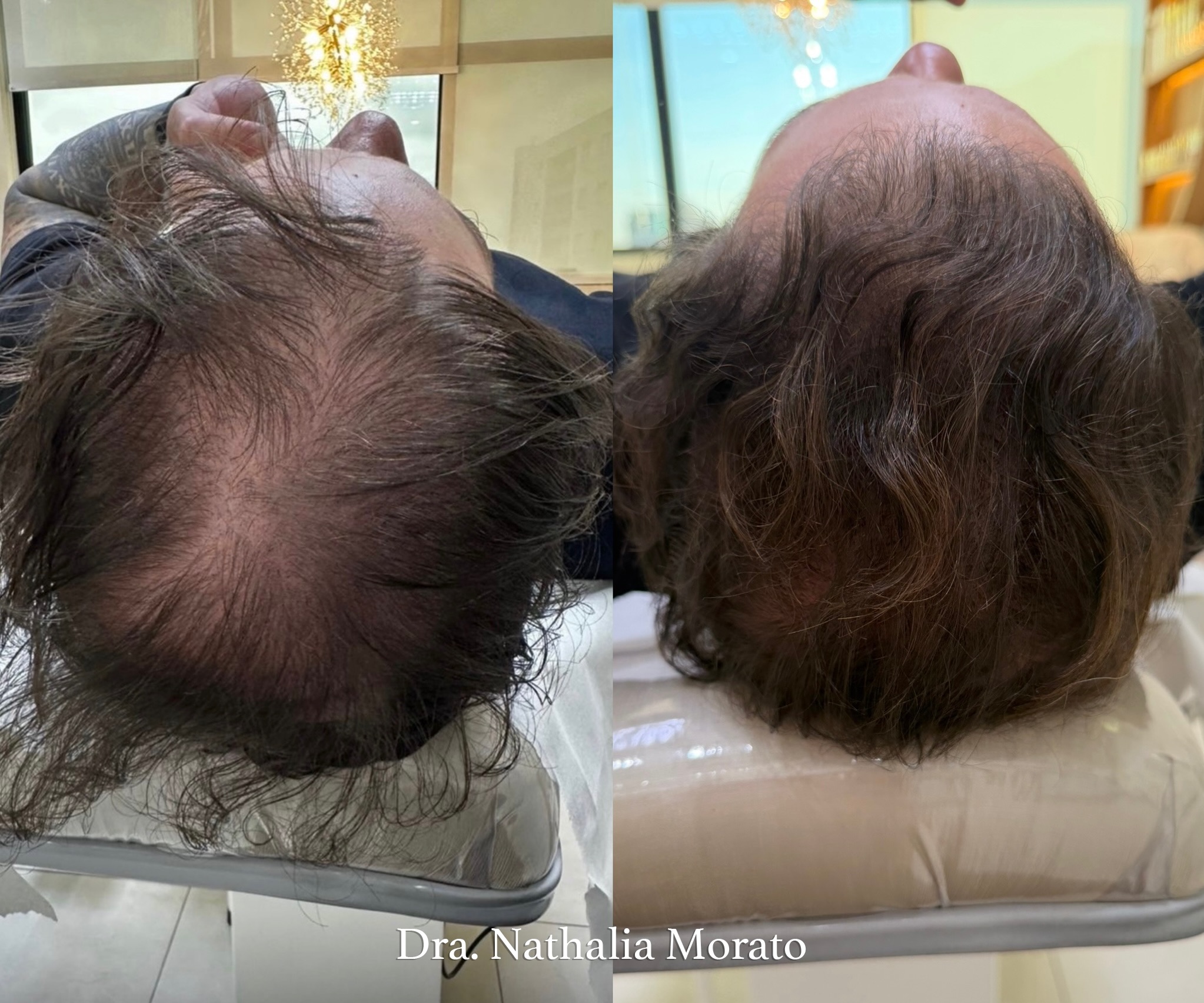 ⚠️ Implante capilar não trata a causa da queda.

Este paciente realizou um implante capilar há 2 anos devido à alopecia androgenética. Mas, sem o tratamento adequado da saúde capilar, em menos de dois anos perdeu praticamente todo o resultado conquistado.

Foi então que ele me procurou.

Após uma avaliação individualizada e um tratamento focado na causa do problema, em apenas 3 meses conseguimos recuperar a saúde do couro cabeludo, fortalecer os fios e devolver um resultado bonito, saudável e natural.

Aqui na clínica, não tratamos apenas a queda de cabelo.

Tratamos a sua saúde capilar de forma completa, personalizada e estratégica, porque cada paciente possui uma causa diferente para a perda dos fios.

🌻 Cabelo bonito não é sorte.
É diagnóstico correto, tratamento individualizado e acompanhamento adequado.

Me conta: você acredita que o implante capilar sozinho resolve a queda de cabelo?

🌻 Vem, que eu cuido de você! 
📲 Agende sua consulta pelo link na bio e descubra o protocolo ideal para tratar a sua queda, afinamento ou calvície com técnica e individualidade!