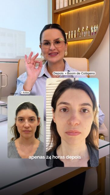 Ultrassom Microfocado HIFU sem limite de disparos +  Bioestimulador de Colágeno 

O que você percebe no espelho:

✨ Melhora da aparência cansada
✨ Melhora do bigode chinês e linha de marionete
✨ Melhora do contorno facial
✨ Contornos reposicionados
✨ Melhora da flacidez facial e do pescoço
✨ Aparência natural, leve e sofisticada
✨ Rosto mais firme
✨ Pele mais jovem

O Boom de Colágeno é para quem sente o rosto perder estrutura e deseja recuperar sustentação com naturalidade e excelência técnica.

Dra. Nathália Morato | Rejuvenescimento Facial
🌻 Agende sua consulta pelo link na bio

📲 (11) 94946-5110
🌐 dranathaliamorato.com.br
📍 R. Antônio Rabello, 222 – Vila Rosália, Guarulhos/SP

#estetica #skincare #beleza #harmonização