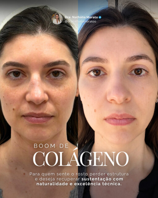 Firmeza, sustentação e rejuvenescimento natural: sem excessos, sem artificialidade

✨ Ultrassom Microfocado HIFU (sem limite de disparos)
Atua profundamente no reposicionamento dos tecidos e fortalecimento da camada muscular, promovendo efeito lifting progressivo.

✨ Bioestimulador de Colágeno
Estimula intensamente a produção natural de colágeno — até 400x mais ativação da resposta fisiológica do organismo — tratando a camada tissular e restaurando firmeza de dentro para fora.

🌻 Agende sua consulta pelo link na bio

📲 (11) 94946-5110
🌐 dranathaliamorato.com.br
📍 R. Antônio Rabello, 222 – Vila Rosália, Guarulhos/SP

#rejuvenescimento #envelhecimento #mulhermadura #guarulhos