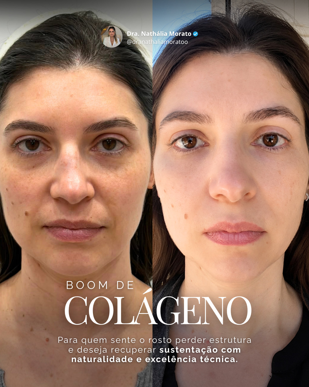 Firmeza, sustentação e rejuvenescimento natural: sem excessos, sem artificialidade

✨ Ultrassom Microfocado HIFU (sem limite de disparos)
Atua profundamente no reposicionamento dos tecidos e fortalecimento da camada muscular, promovendo efeito lifting progressivo.

✨ Bioestimulador de Colágeno
Estimula intensamente a produção natural de colágeno — até 400x mais ativação da resposta fisiológica do organismo — tratando a camada tissular e restaurando firmeza de dentro para fora.

🌻 Agende sua consulta pelo link na bio

📲 (11) 94946-5110
🌐 dranathaliamorato.com.br
📍 R. Antônio Rabello, 222 – Vila Rosália, Guarulhos/SP

#rejuvenescimento #envelhecimento #mulhermadura #guarulhos